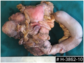 Whipple for Pancreatic Neuroendocrine tumor Whipple for Pancreatic Neuroendocrine tumor